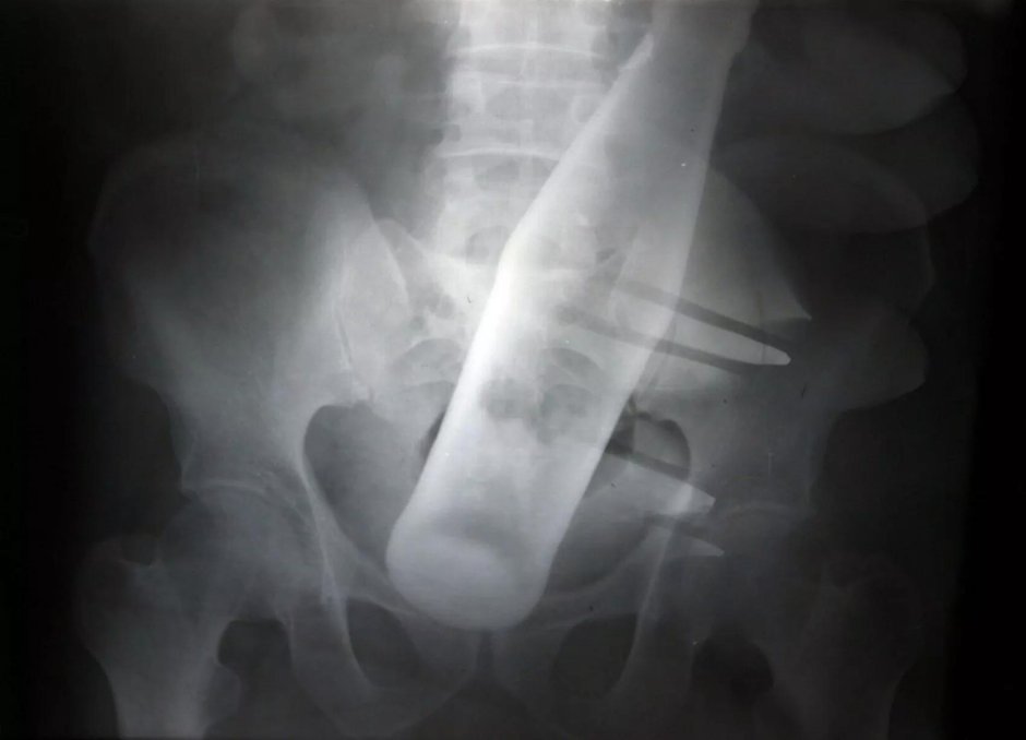 Инородное тело прямой кишки