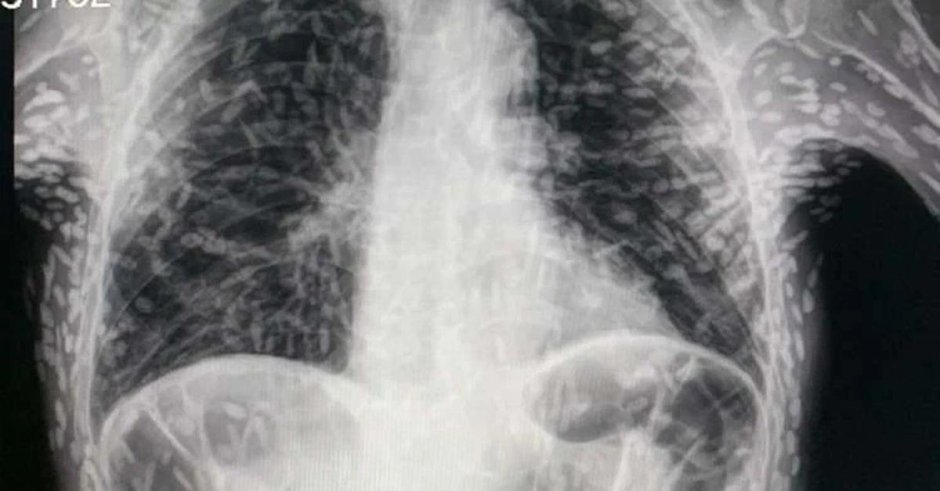 Легкие на рентгене