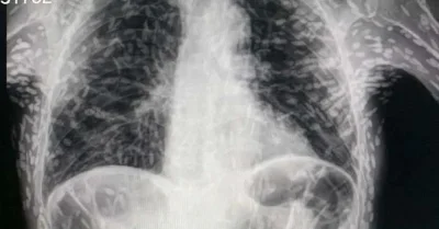 Легкие на рентгене