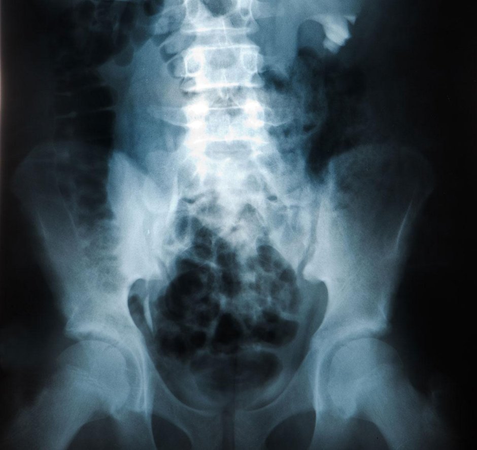 Рентген пояснично-крестцового отдела в 2 проекциях