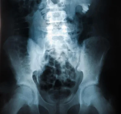 Рентген пояснично-крестцового отдела в 2 проекциях