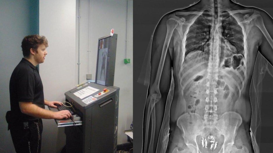 Сколиоз поясничного отдела позвоночника рентген