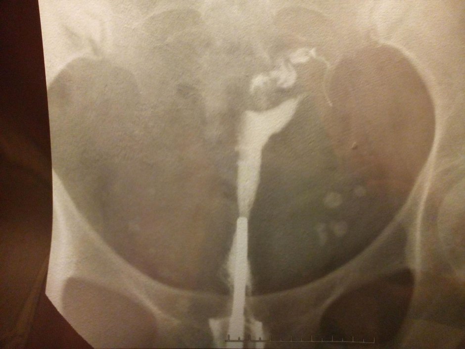 Гидросальпинкс на гсг