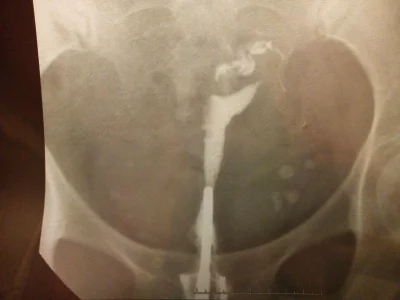 Гидросальпинкс на гсг