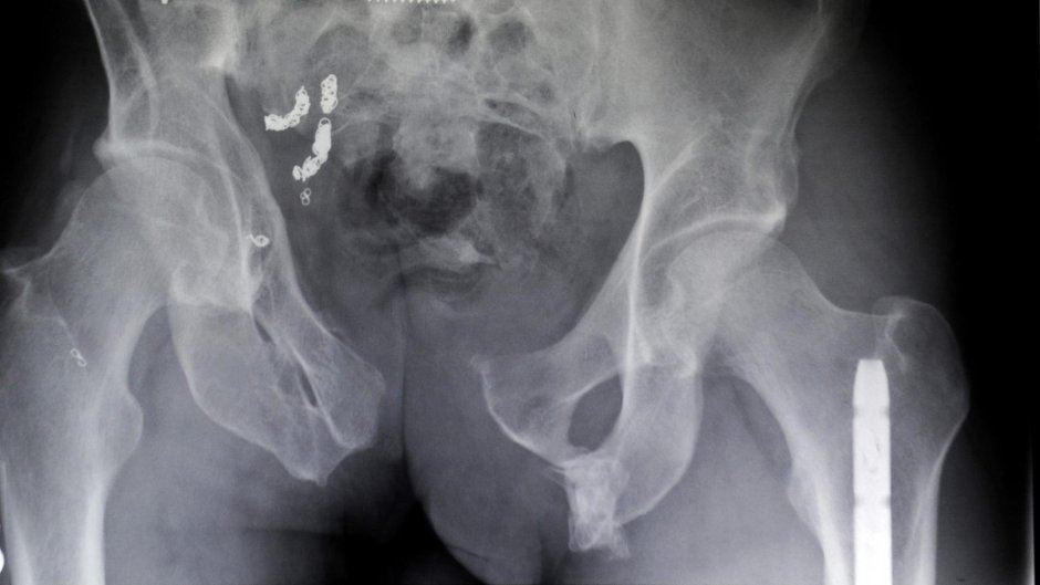 Перелом подвздошной кости рентген