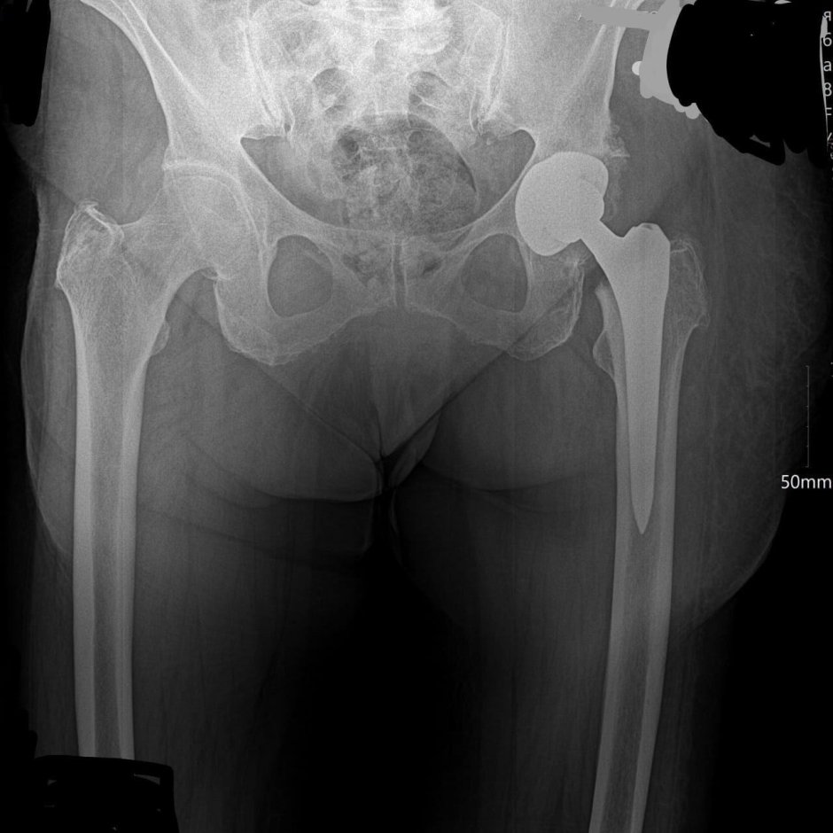 Коксартроз эндопротезирование тазобедренного сустава