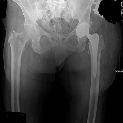 Коксартроз эндопротезирование тазобедренного сустава