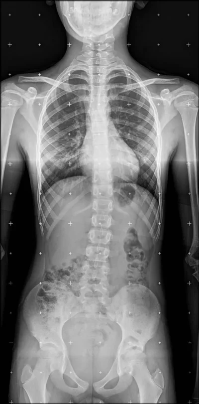 Abdominal x ray