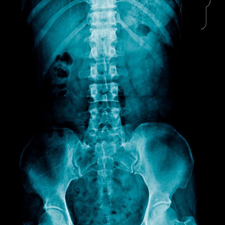 Позвонки поясничного отдела рентген