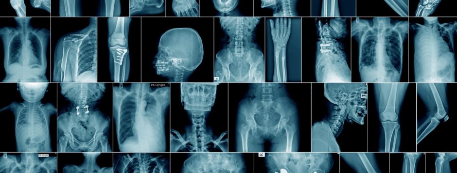 Рентген костей