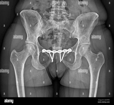 Рентген снимок тазобедренного сустава