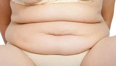 Складки жира