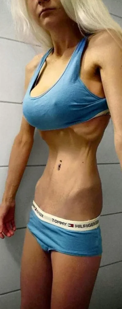 Ожирение после анорексии