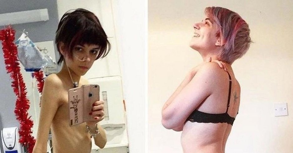 Хилькевич анна анорексия анорексия