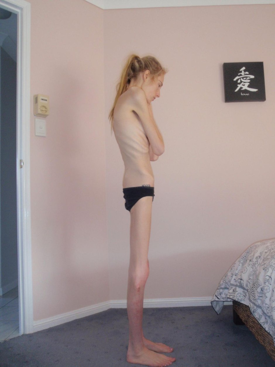 Больные анорексией