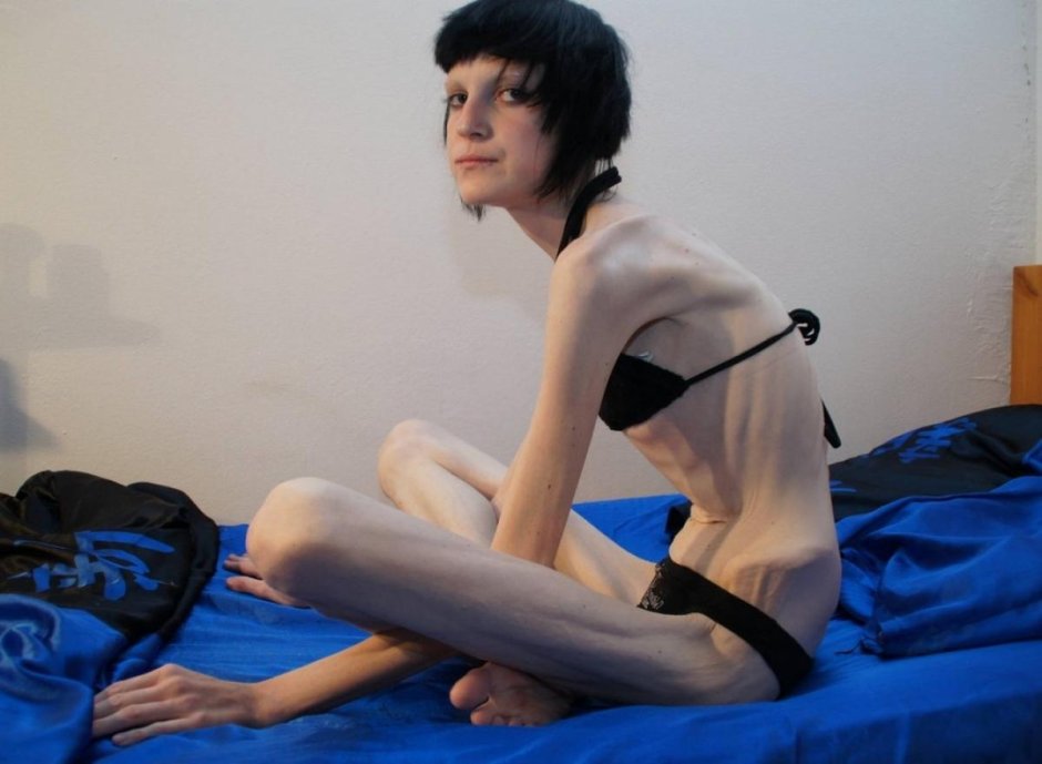 Голые больные анорексией