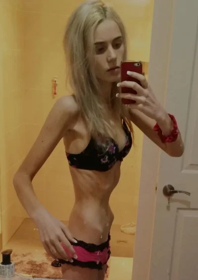 Анорексичка мишель алессандро