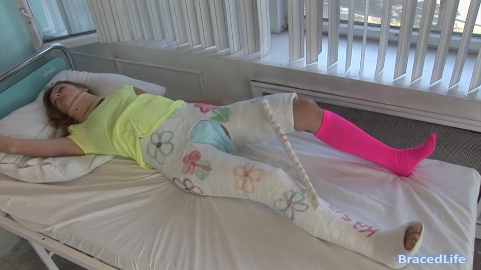 Девушка в гипсе полностью