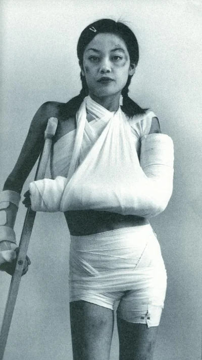 Реабилитация после эндопротезирования коленного сустава дома