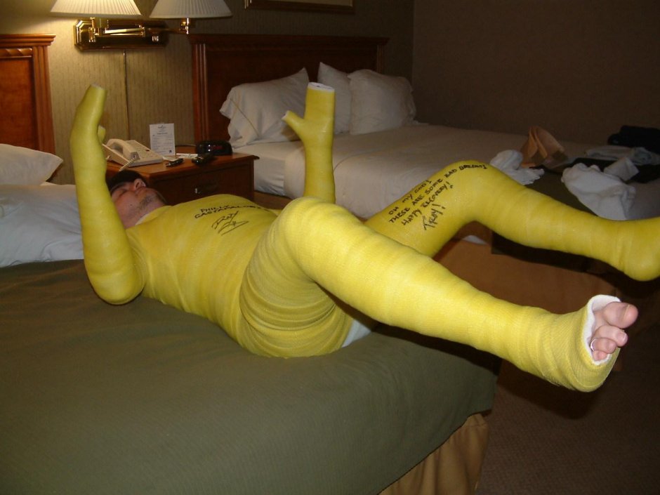 Гипс при переломе