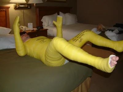 Гипс при переломе