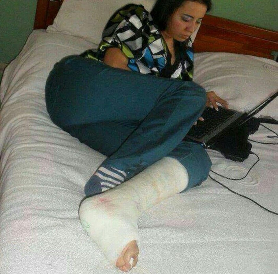 Гипс на ноге