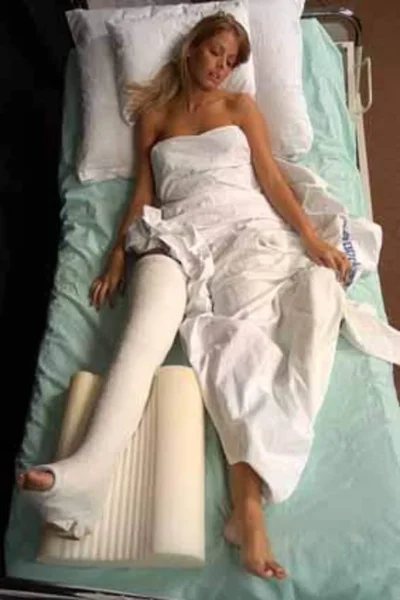 Гипс при переломе