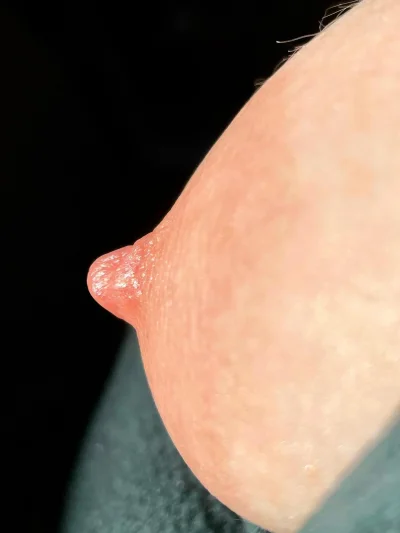 Маммография микрокальцинаты