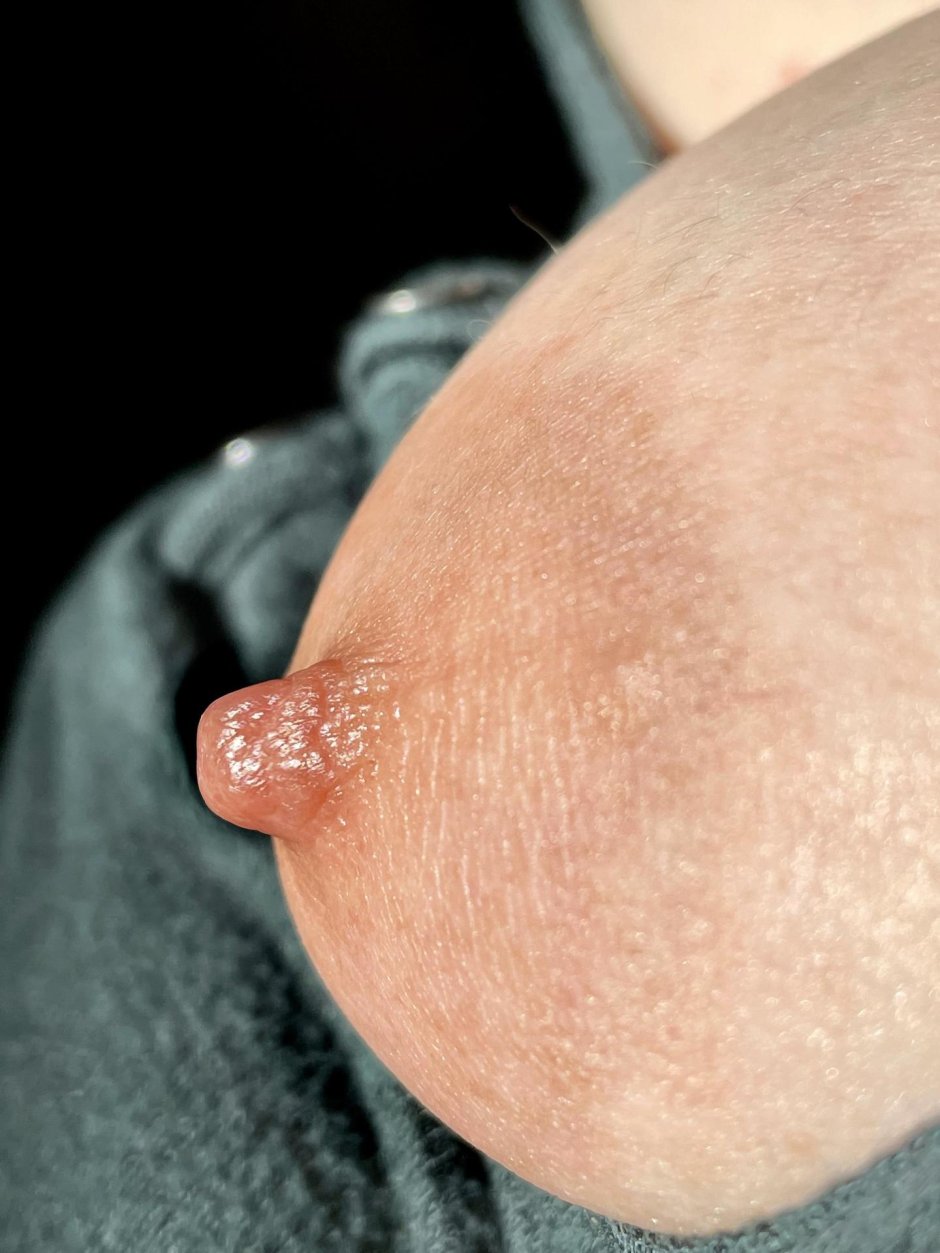 Фиброз груди