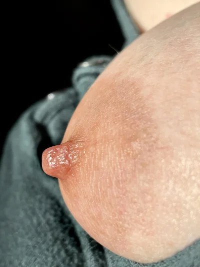 Фиброз груди