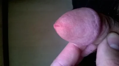 Трещины на головке полового члена