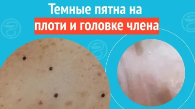 Белые пятна на плоти члена