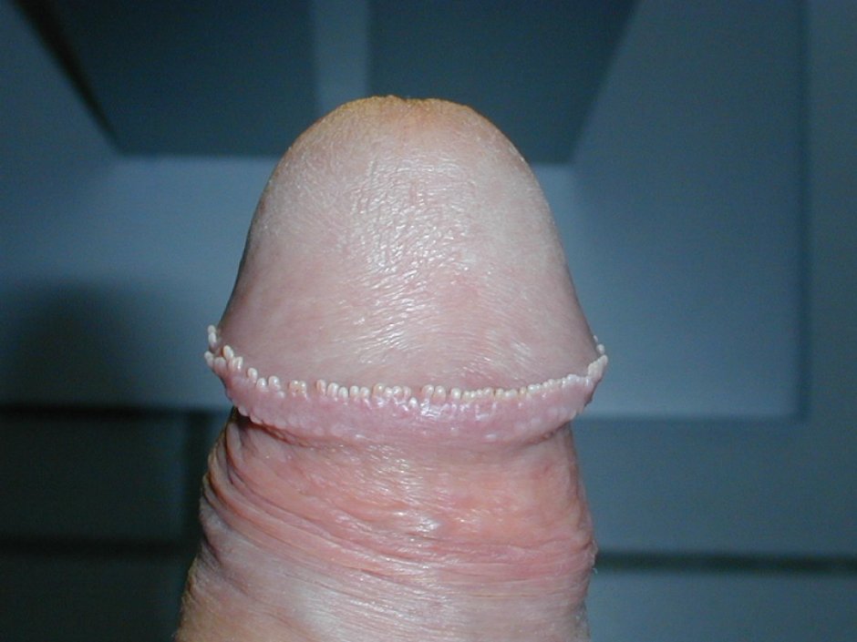 Волосы на головке пениса