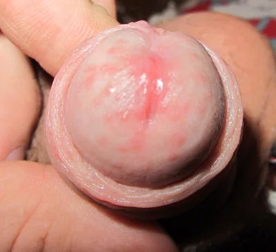 Покраснение вокруг уретры