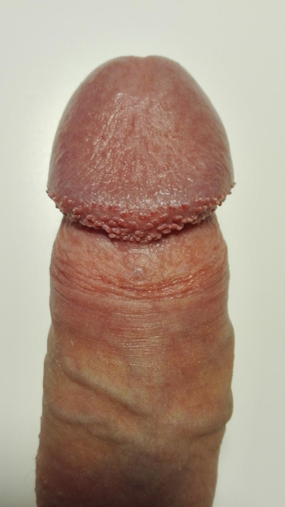 Перламутровые папулы полового члена