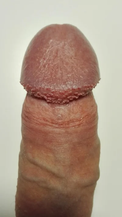 Перламутровые папулы полового члена