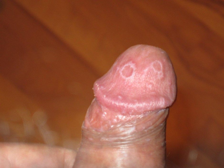 Пустулезный псориаз