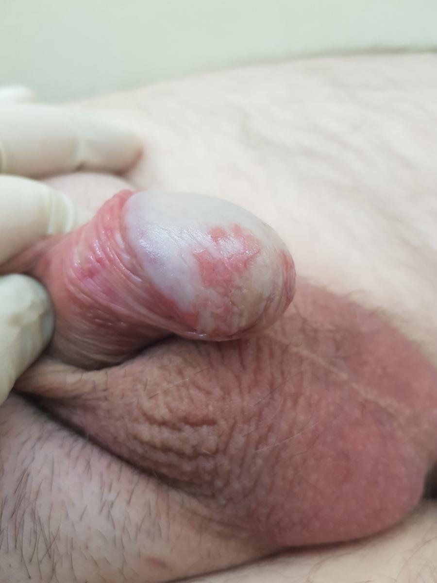 Цирцинарный баланопостит