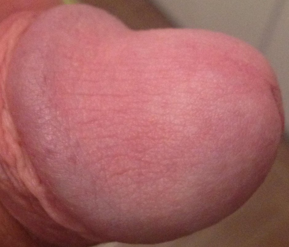 Покраснение головки члена