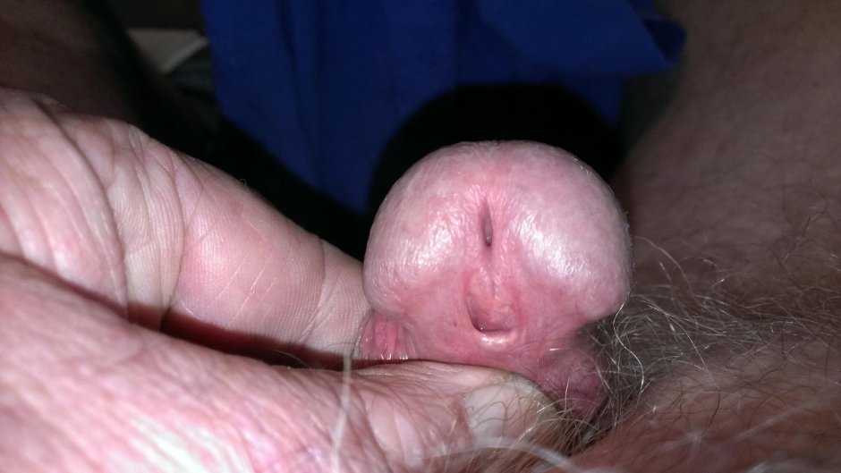 Гипоспадия крайняя плоть