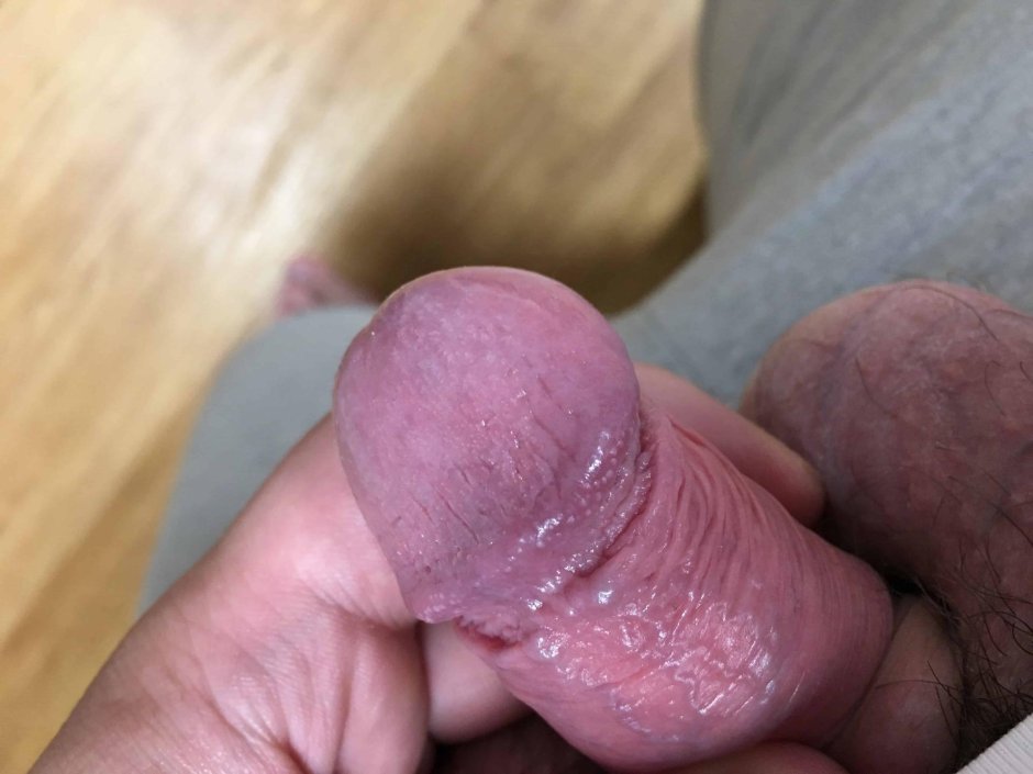 Пупырышки на головке пениса