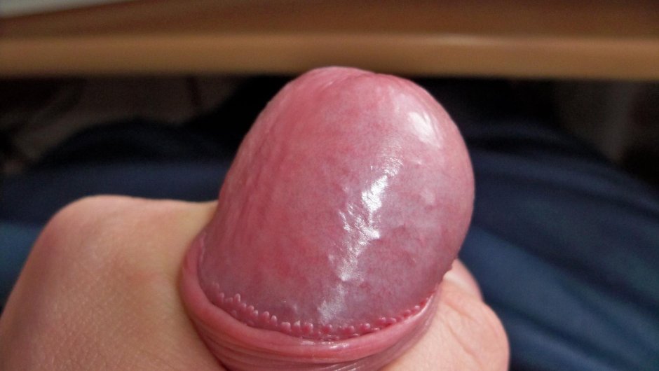 Подзалупный творожок смегма