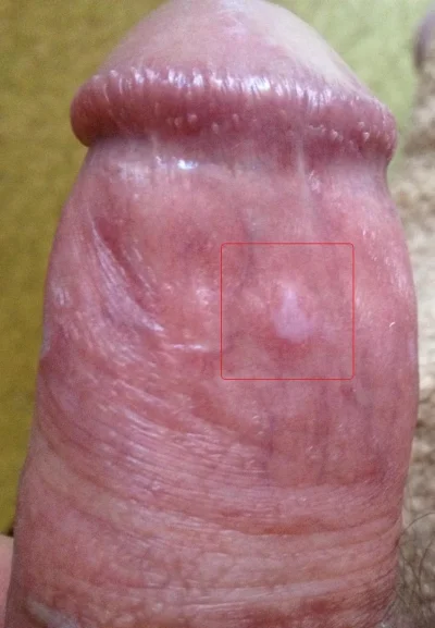 Сифилис на члене