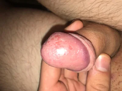 Красная сыпь на головке члена