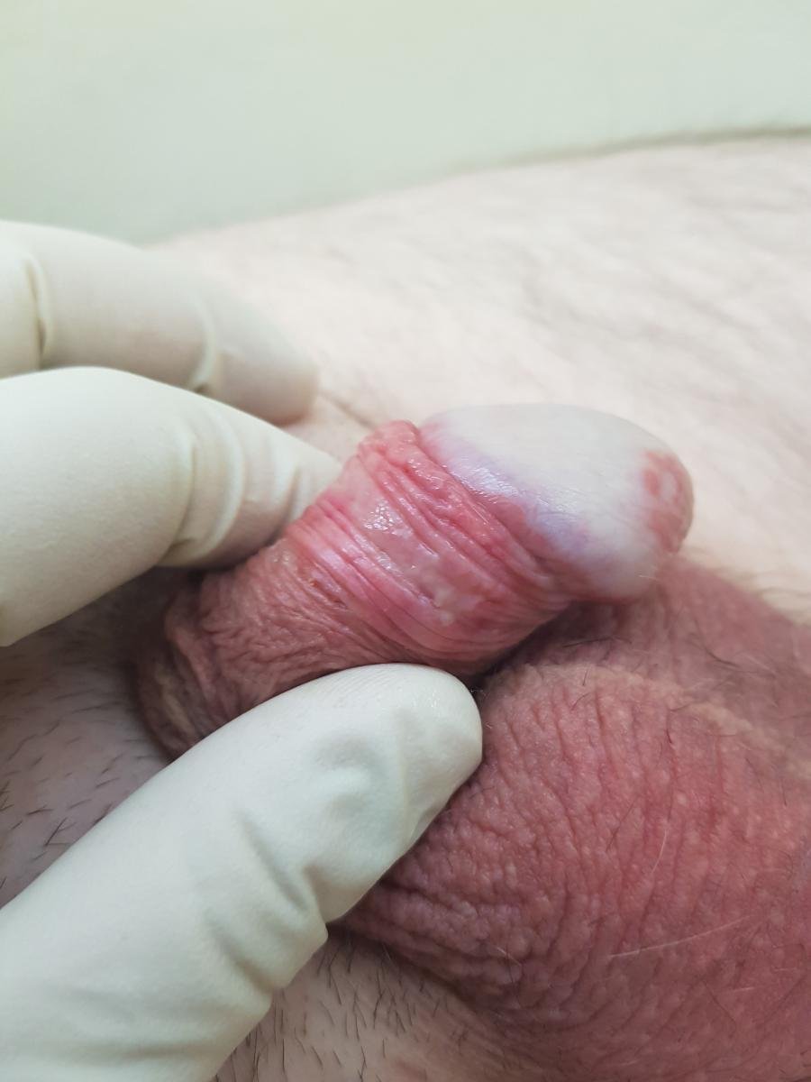 Крайняя плоть полового члена