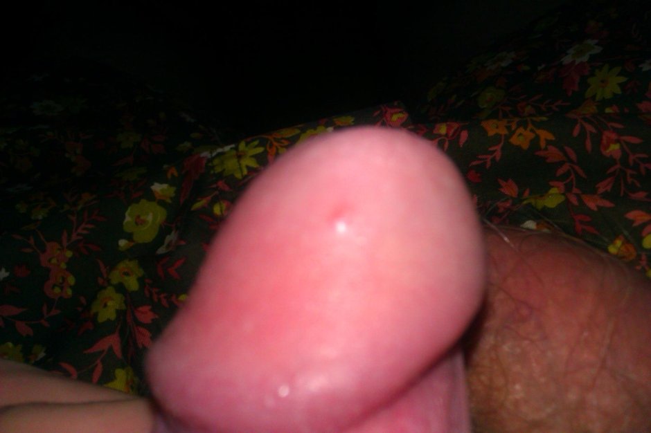 Мелкие прыщи на залупе