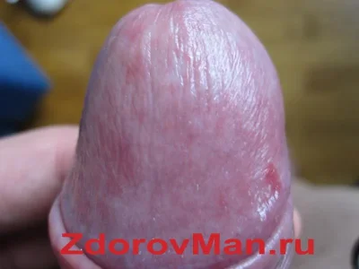 Кандидоз баланопостит
