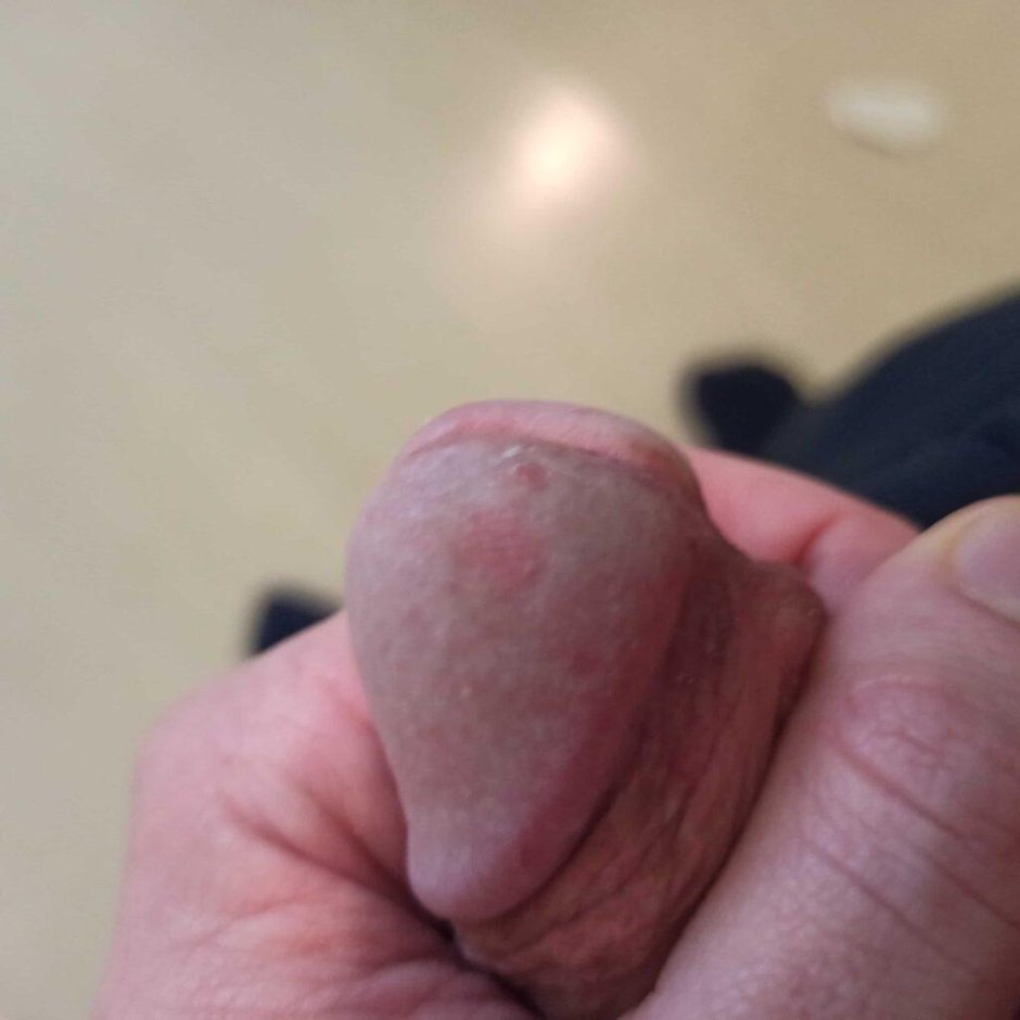 Прыщи на головке