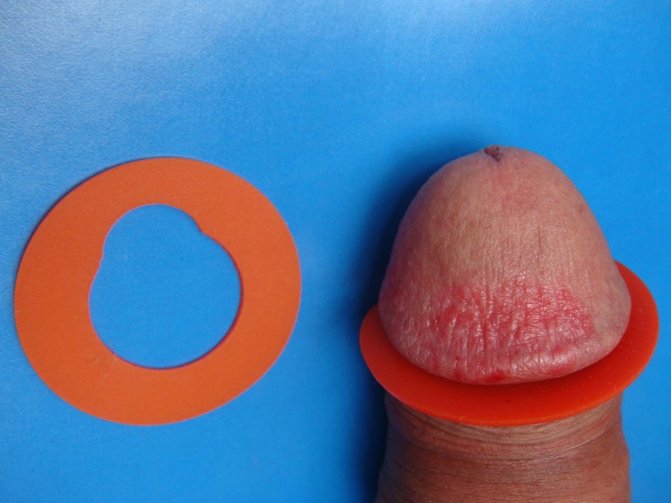 Ксеротический баланит