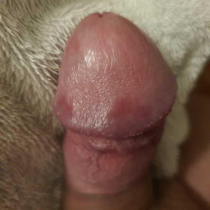 Трещины на пенисе